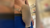 Colostomy Bag Full of Poop